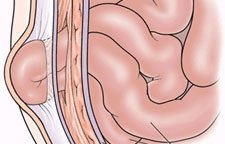 hernia_d